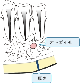 MCW Mandibular Cortical Width